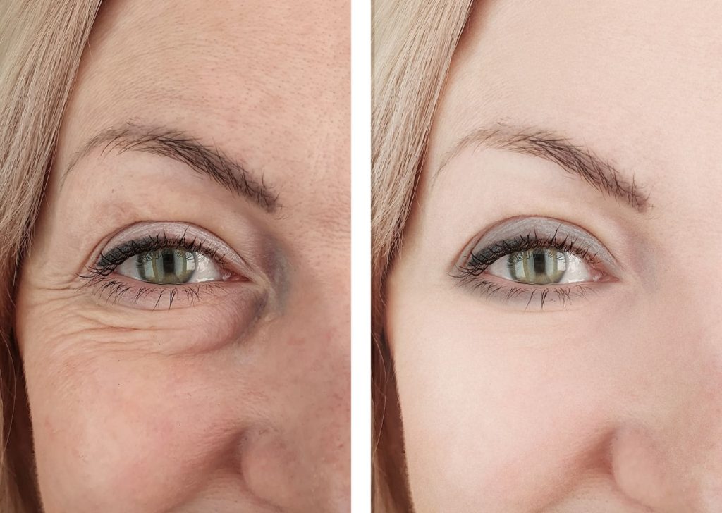 Peau éclatante sans injection grâce au soin JetPeel