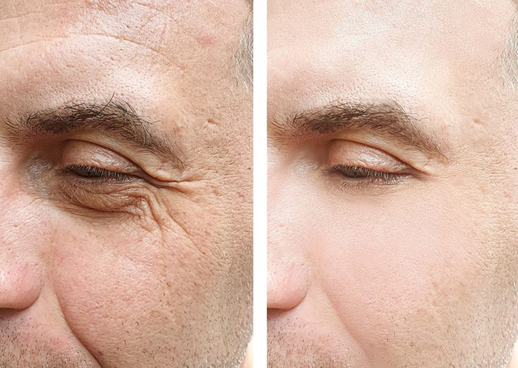Résultat lifting visage non invasif avec RF REACTION