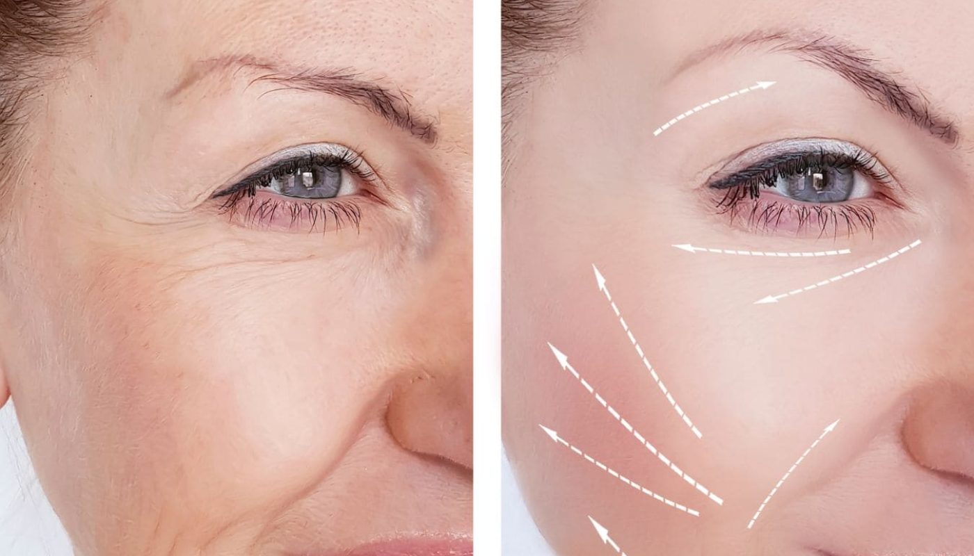 Peau éclatante sans injection grâce au soin JetPeel